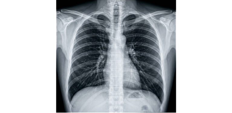 x-ray