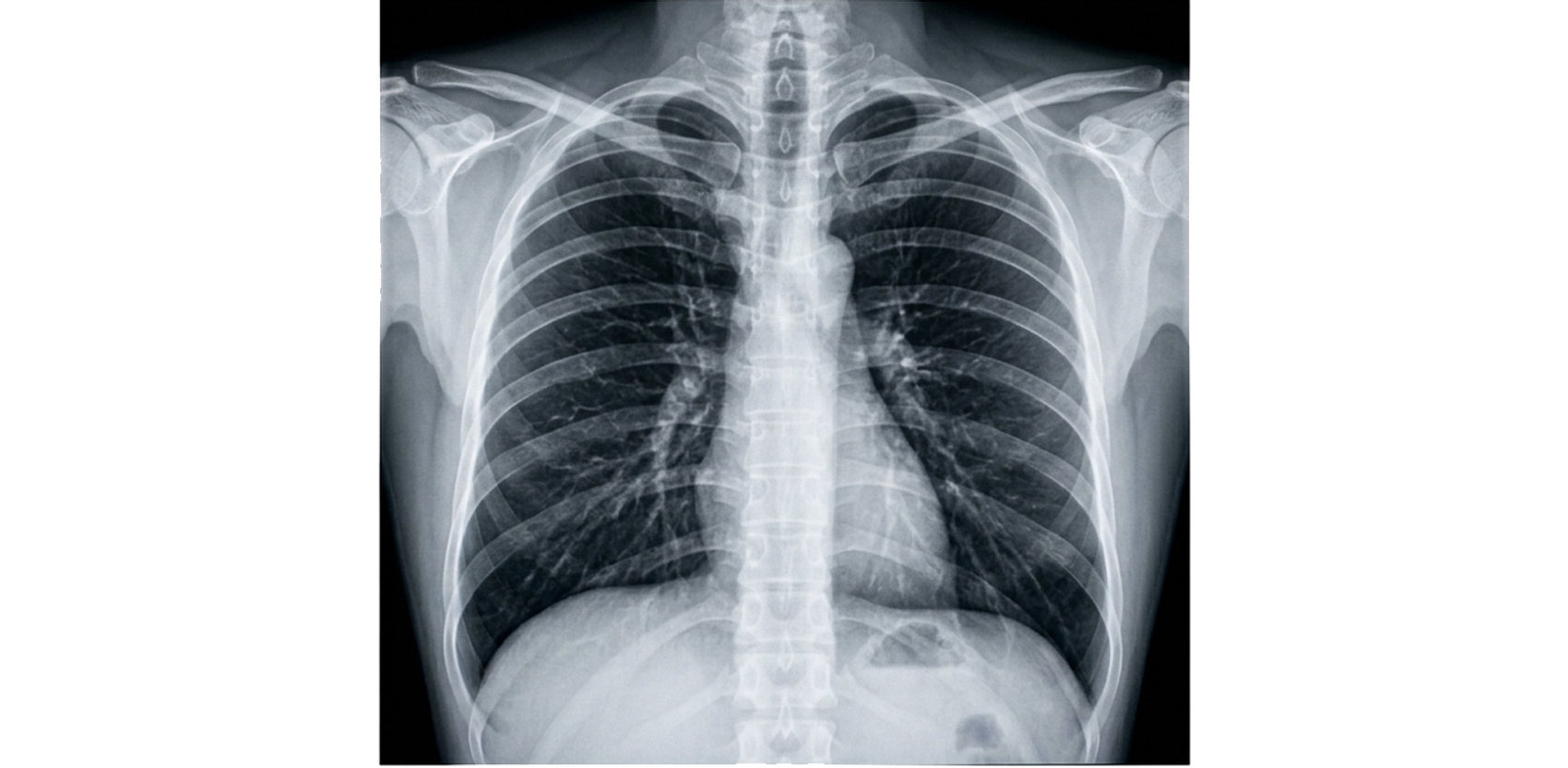 x-ray